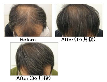 AGA治療